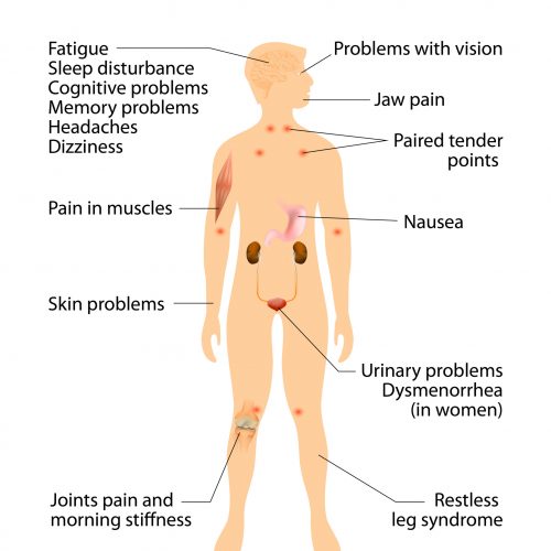 signs and symptoms of fibromyalgia. Human silhouette with internal organs. Vector illustration